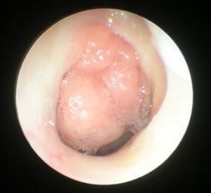 Adenoides (megnagyobbodott mandulával)