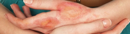 Alergiile cutanate