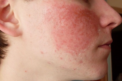 allergia bőr
