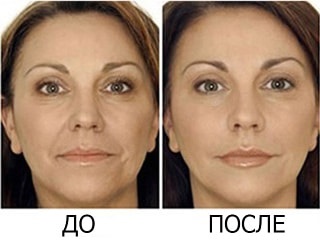 Ce este mezoterapia facială și mezoterapia celulitei, contraindicații și metode de conducere