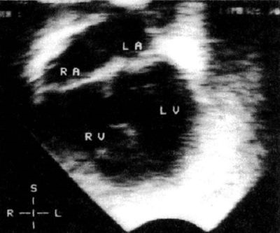 Defectul septului interventricular (dmjp) - cardiolog - un loc despre bolile inimii și vaselor de sânge