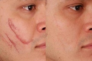 Dermaticile recenzii, cicatrici foto înainte și după, preț