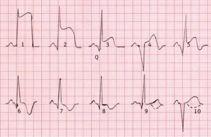 Condiții asemănătoare cu infarctul ECG și sindroame, simptome de aritmie și tratament în Belarus