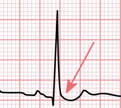 Extrasystoles - care sunt simptomele și diagnosticul?