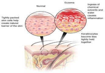 Tratamentul eczemelor