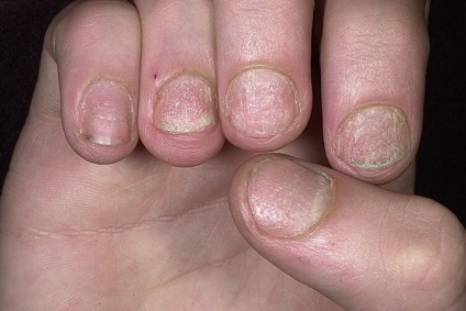 Eczemă pe mâini - mai mult de 10 ani de chin