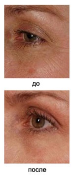 Fracțional cu laser (fotothermoliza) - prețul, procedura de cosmetologie a fotorejuvenării pielii facială în