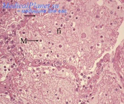 Histopatologie bronhopneumonie