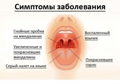 Purulente dureri în gât cât durează, cauze, antibiotice pentru tratament