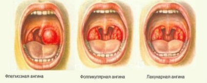 Purulente dureri în gât cât durează, cauze, antibiotice pentru tratament