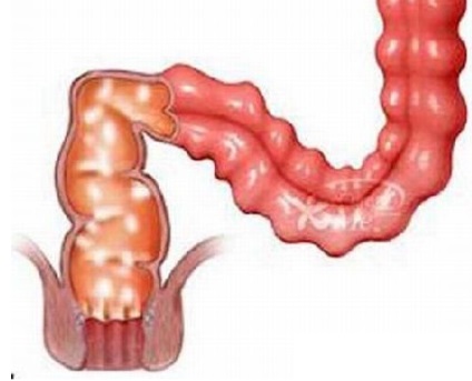 Colită granulomatoasă și enterită regională