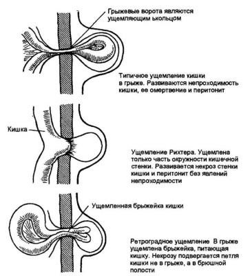 Sérv, sérv bebörtönzés és diagnózis