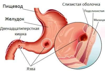 Herniation of stomach - ce este aceasta, cum să tratăm
