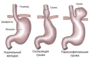 Herniation of stomach - ce este aceasta, cum să tratăm