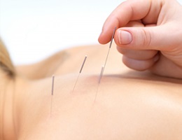 Acupunctura de la fumat