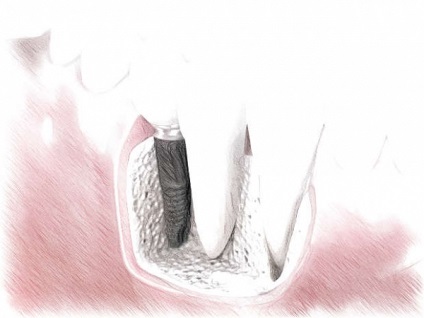 Implantarea etapelor și calendarului dinților
