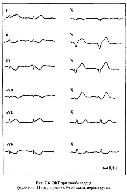 Modificări asemănătoare infarctului în ecg în alte boli și condiții