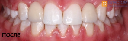 Malocclusion fogászati ​​diastema