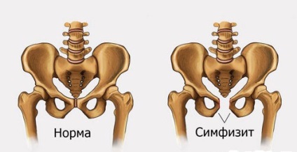 Cum se face articulația articulară (simfiză) în timpul sarcinii?