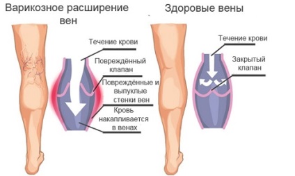 Как да се отървем от разширени вени на краката по прост начин