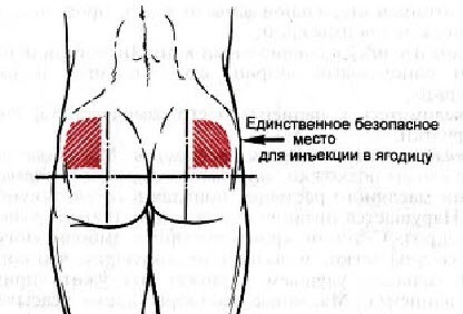 Cum se administrează de sine o injecție intramusculară