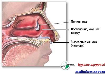 Как да премахнете полипи без хирургия - бъдете здрави! Медицински портал на Нижни Новгород
