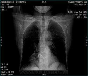 Simptomele cardio-diafragmatice ale lipomului, diagnosticul și tratamentul