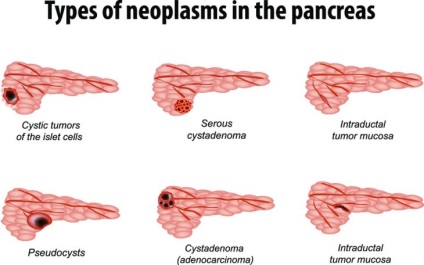Chistul simptomelor și tratamentului pancreasului