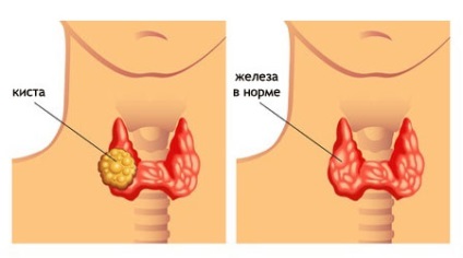 Chistul glandei tiroide tip de boală și metode de tratament