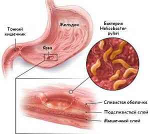 Calearea laser a ulcerului gastric - ulcerul peptic -if () - endif - catalogul articolelor - proctologia -