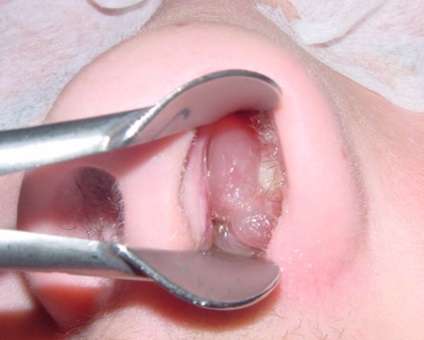 Tratamentul polipilor în nas