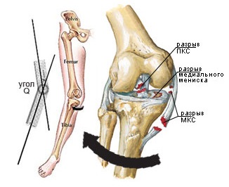 Tratamentul rupturilor și leziunilor ligamentelor articulației genunchiului cu ajutorul operațiilor artroscopice