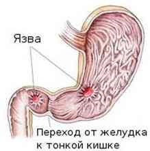 Tratamentul ulcerului gastric cu ulcerul laser - peptic -if () - endif - catalogul de articole - proctologie -