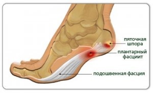 Kenőcs származó sarkantyú (talpi fasciitis) okai, tünetei, diagnózisa