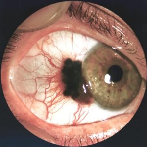 Melanomul ochilor provoacă, simptome și tratament