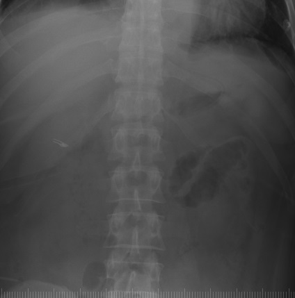 Tehnologia minim invazivă a tratamentului chirurgical al retroperitoneal infectate necrotizante