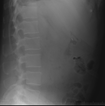 Tehnologia minim invazivă a tratamentului chirurgical al retroperitoneale infectate necrotizante