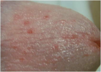 Este posibil să se prevină apariția acneei după un curs de steroizi?