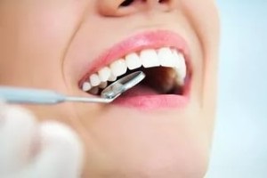 Este posibilă îndepărtarea cariilor din dinți pentru a trata cariile într-o clinică scumpă, un efect dentar