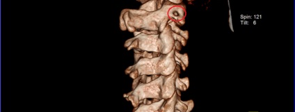 Semne MR de hipoplazie a arterei vertebrale drepte