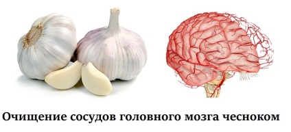 Purificarea vaselor cerebrale cu usturoi - retete pentru tratament de la fitoterapeut Halisat Suleimanova