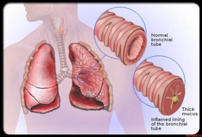 Meghatározása és differenciáldiagnózisa akut, krónikus bronchitis és a tuberkulózis, a