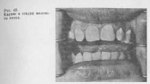 Pathohistologia cariilor dentare, stomatologiei terapeutice