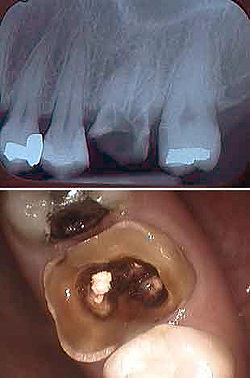 Fractura dintelui - cauze, simptome, diagnostic si tratament