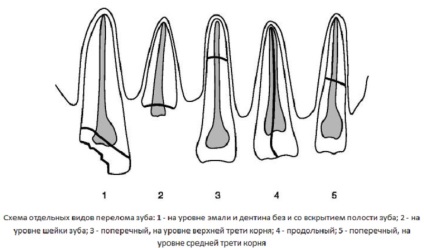 Hosszanti és keresztirányú törését a fogat a gyökér és a korona a tünetek, a kezelés