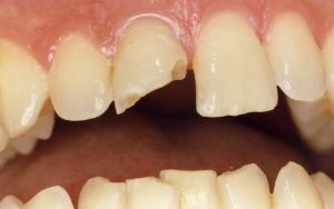 Надлъжни и напречни фрактура на зъба в корените и короната симптоми, лечение