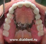 Protetica dentară - proteze amovibile foarte estetice