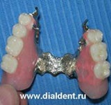 Protetica dentară - proteze amovibile foarte estetice