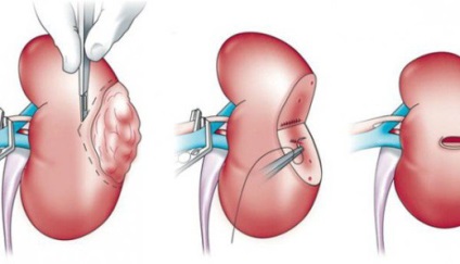 Rinichii cauzate de cancer, simptome, etape de dezvoltare, tratament