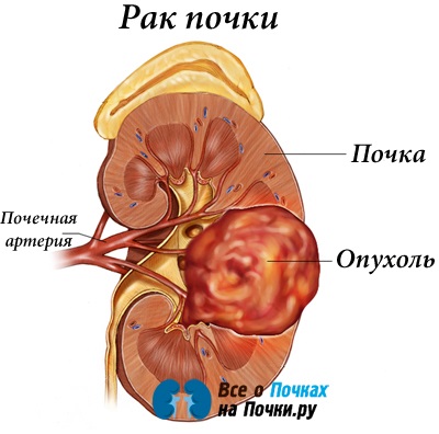 Cancerul de rinichi la bărbați și femei continuă viața
